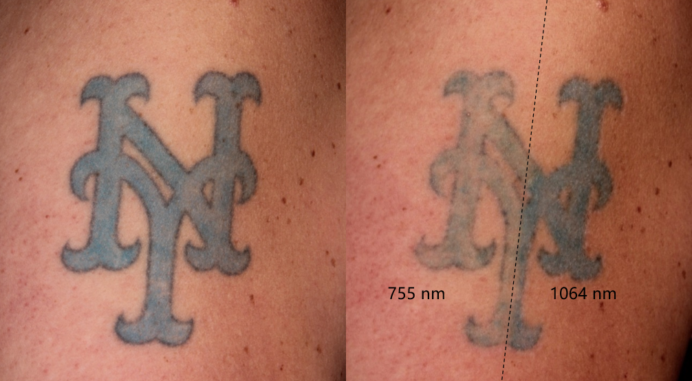 Product usage images for Tattoo Removal Machines